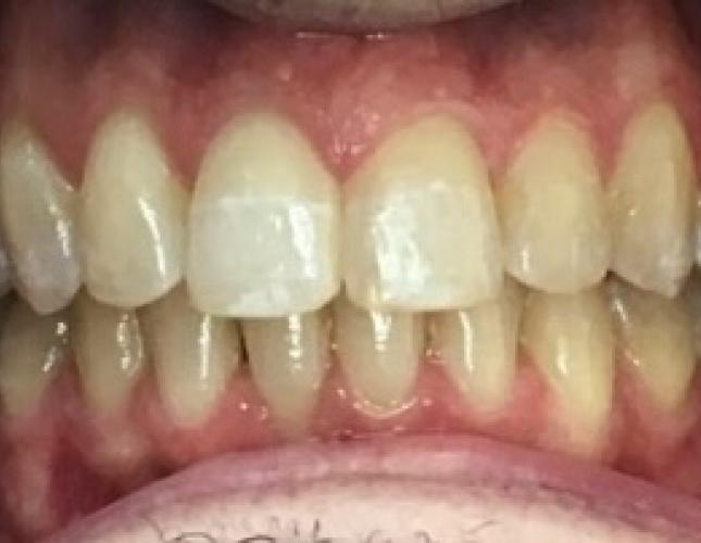 Invisalign Case 3 after