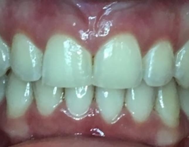 Invisalign Case 4 after