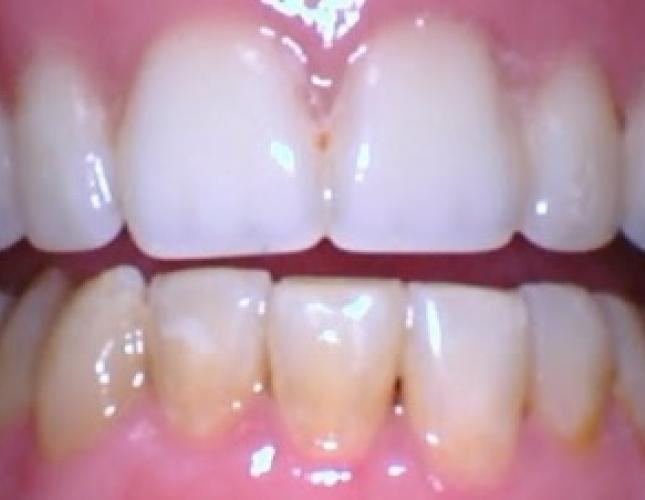 Upper Dentures after