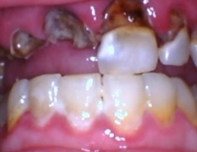 Upper Dentures before