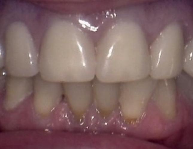 Upper Dentures & Fillings after