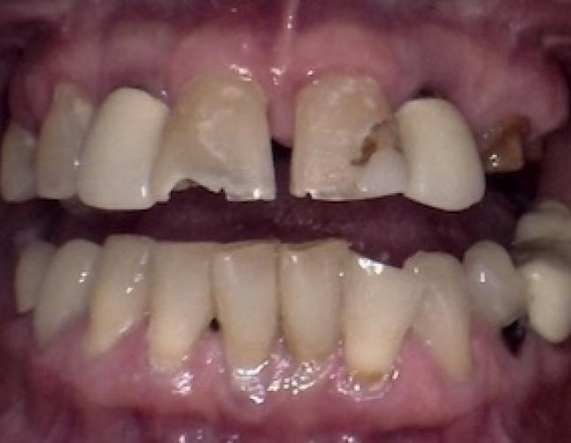 Upper Dentures & Fillings before