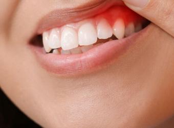 Gingivitis 101: Understanding the Basics of Gum Inflammation